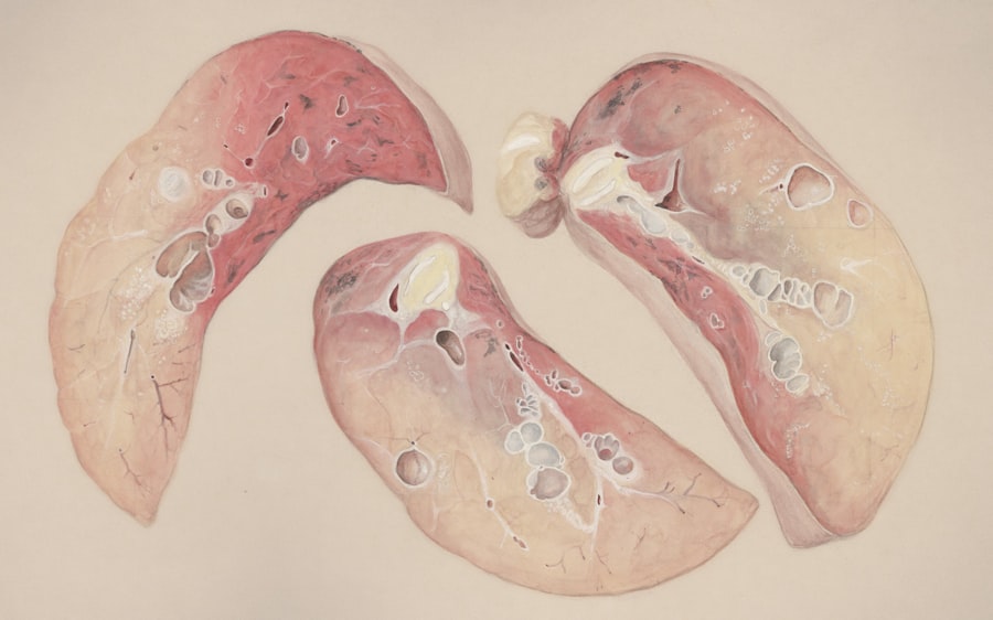 fatty liver disease