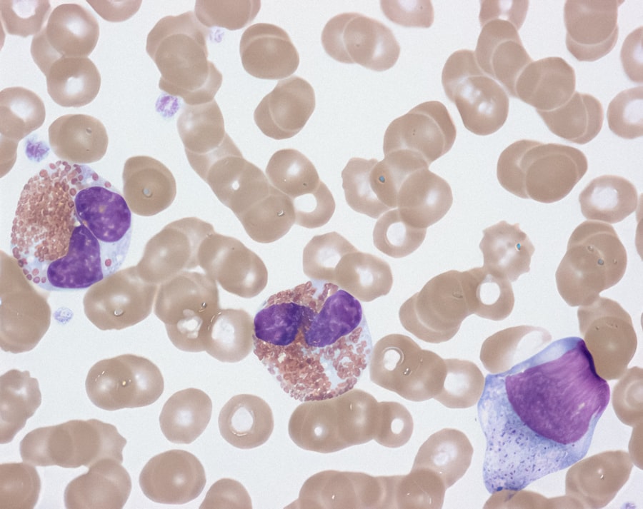 Photo Hemochromatosis Symptoms