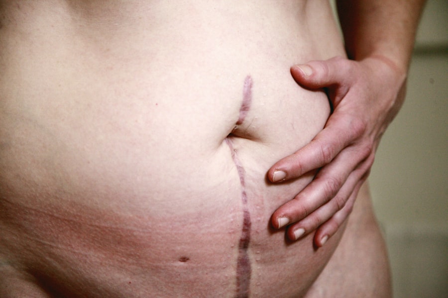 Photo reverse non alcoholic fatty liver disease