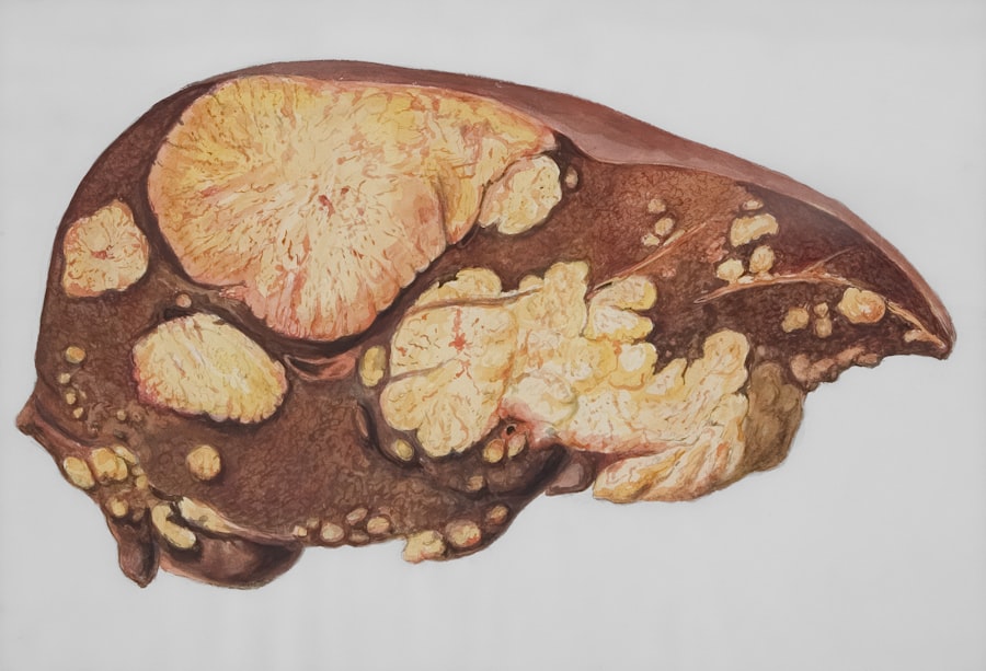 Photo fatty liver